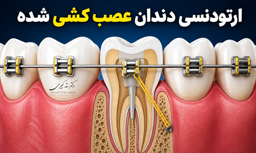 ارتودنسی دندان عصب کشی