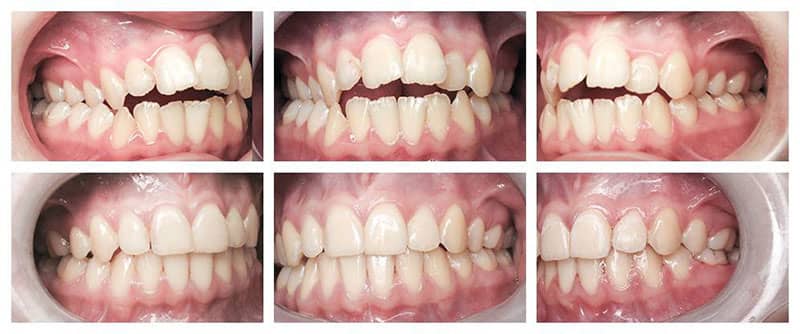 طول درمان ارتودنسی دندان کودکان
