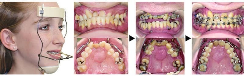 ارتوپدی فکی یکی از روش های ارتودنسی دندان