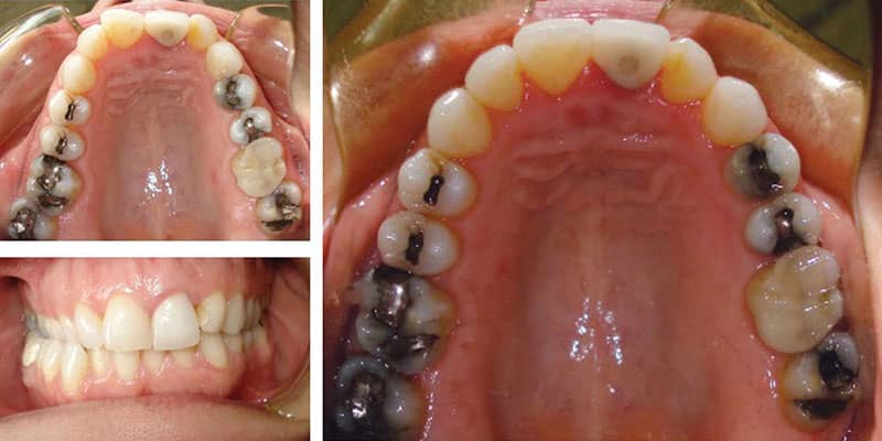 آیا ارتودنسی بر روی دندانی که عصب کشی شده خطر دارد