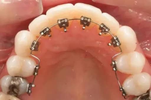 موفقیت درمان ارتودنسی روی دندان عصب کشی شده