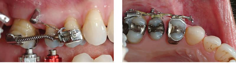 ارتودنسی دندان عصب کشی شده آیا امکان پذیر است