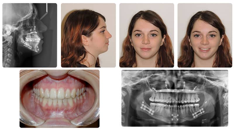 ارتوسرجری یکی از روش های ارتودنسی دندان
