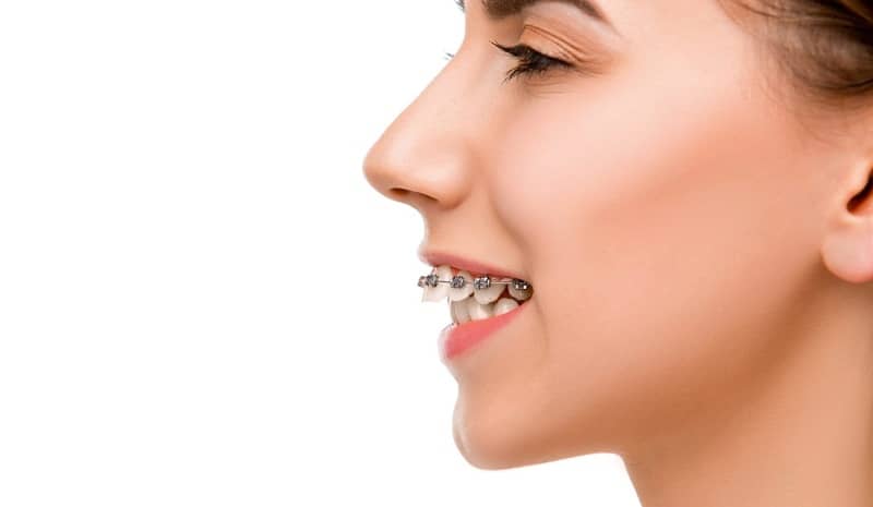 اختلال اوربایت دندان