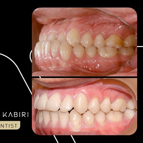 اصلاح مشکل جلوزدگی فک بالا و عقب بودن فک پایین توسط دکتر کبیری