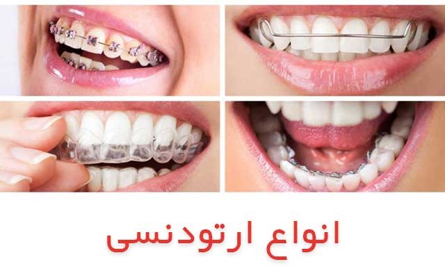 انواع ارتودنسی دندان