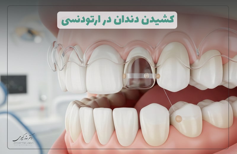 کشیدن دندان در ارتودنسی