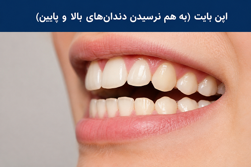 اپن بایت یا بهم نرسیدن دندان ها