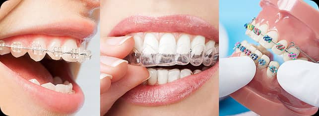 تاثیر نوع ارتودنسی در هزینه ی ارتودنسی دندان