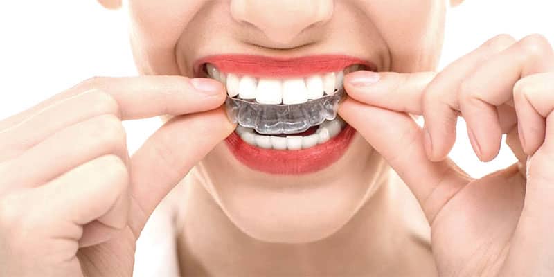 عوامل موثر در هزینه ی ارتودنسی دندان