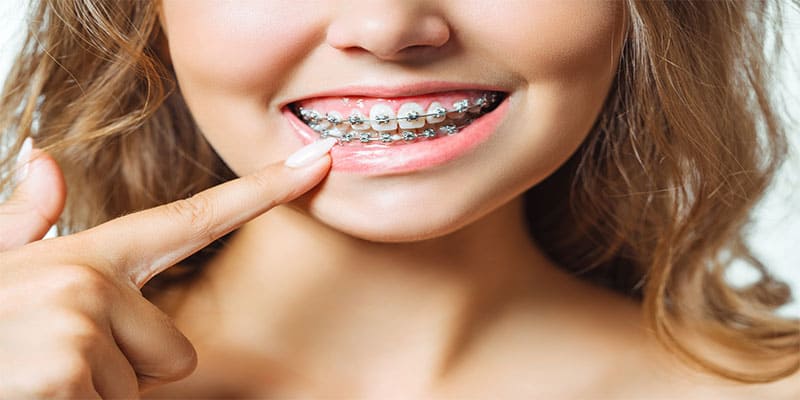 ارتودنسی ثابت دندان چیست؟