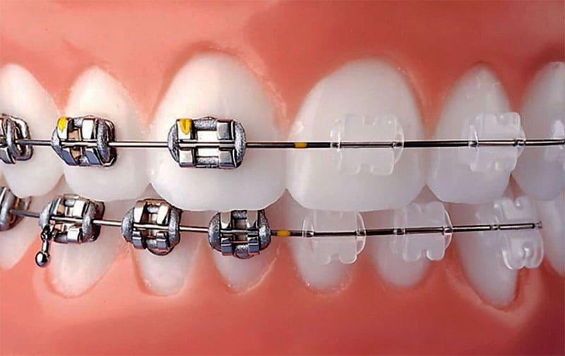 انواع ارتودنسی ثابت دندان کدام اند