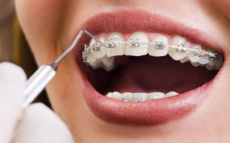 هزینه ی ارتودنسی دندان در کرج چقدر است