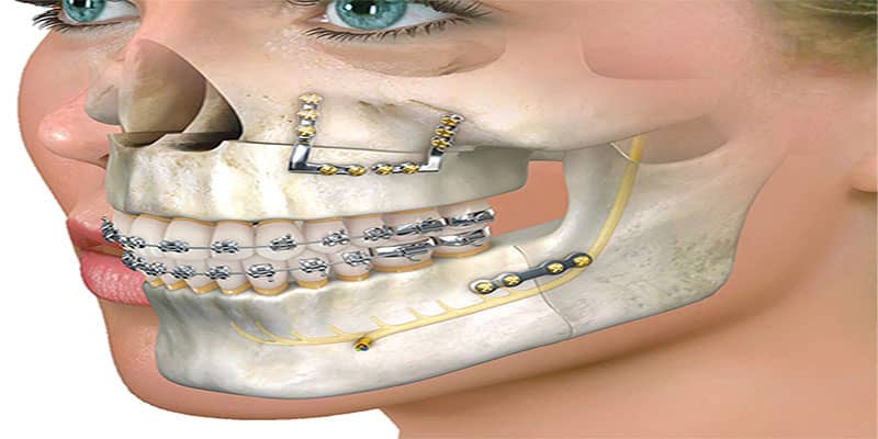 جراحی فک در انجام ارتودنسی