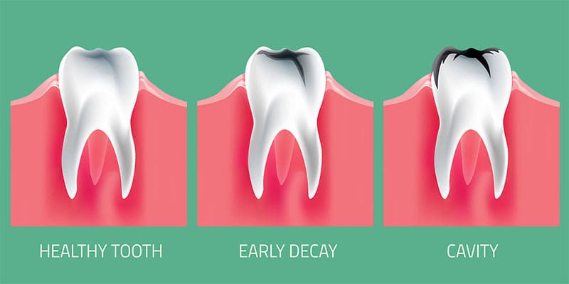 درمان پوسیدگی دندان