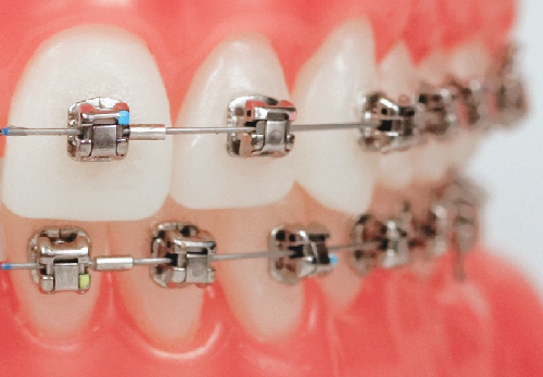 ارتودنسی دیمون