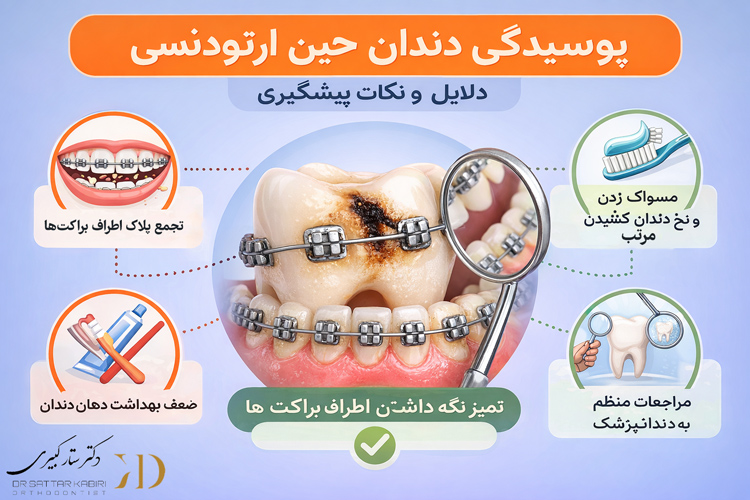 پوسیدگی دندان در ارتودنسی
