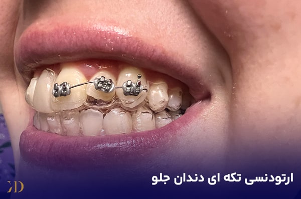 ارتودنسی دندان های جلو