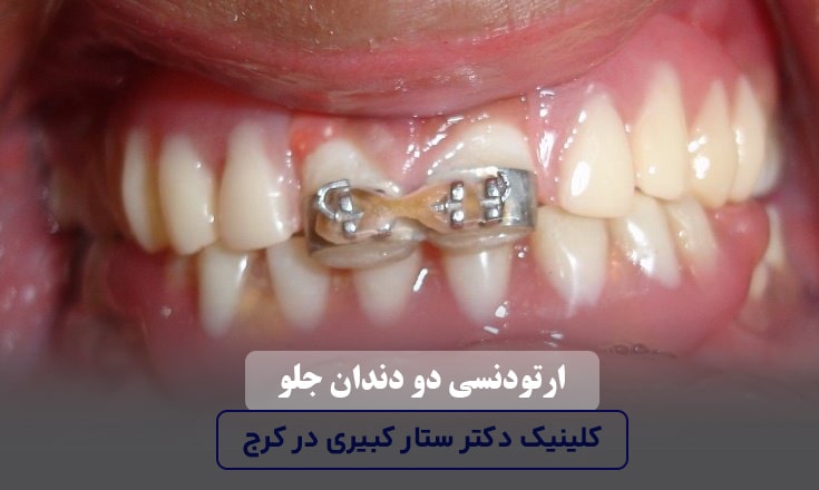 ارتودنسی دو دندان