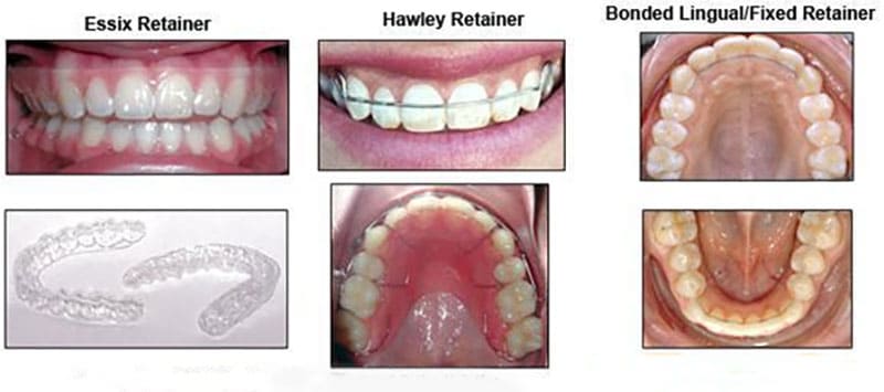 مزایا و معایب انواع نگهدارنده ارتودنسی چیست؟