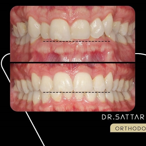 درمان دیپ بایت با ارتودنسی توسط دکتر کبیری