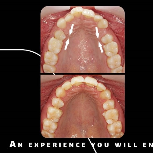 درمان همپوشانی شدید دندان با ارتودنسی