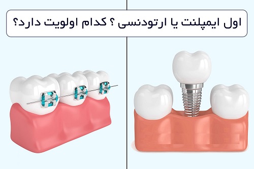 اول ایمپلنت یا ارتودنسی