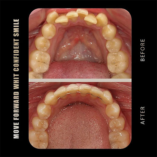 نمونه درمان ارتودنسی دندان دکتری کبیری