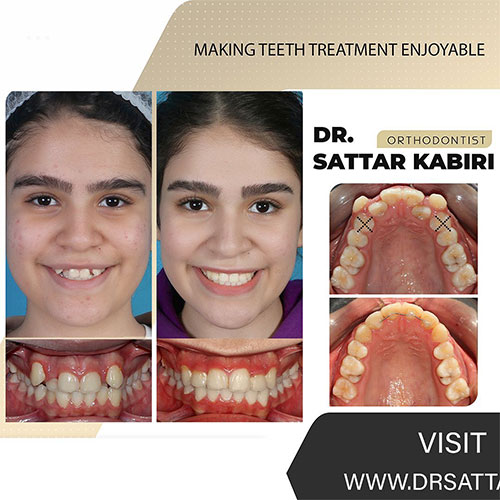نمونه درمان کشیدن دندان در ارتودنسی
