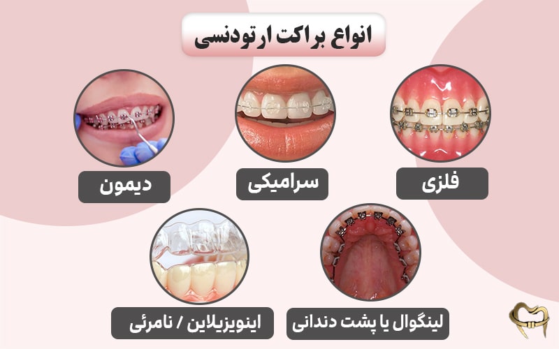 انواع براکت ارتودنسی چیست و کدام بهتر است؟