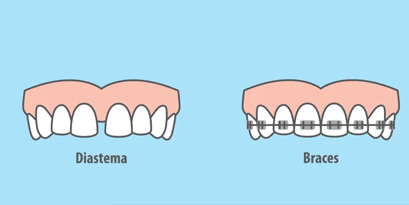 علت ایجاد دیاستما یا افزایش فواصل بین دندانی