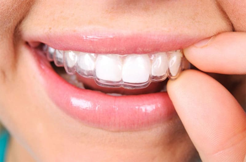 بهترین روش ارتودنسی برای دندان های روکش شده چیست؟
