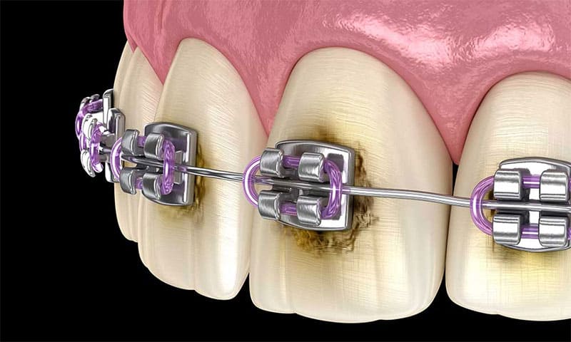 عدم جر گیری دندان در طول ارتودنسی چه مشکلاتی ایجاد می کند؟