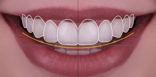 اصلاح طرح لبخند با ارتودنسی چگونه است