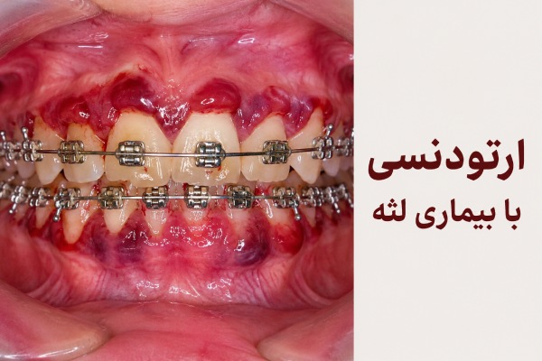 ارتودنسی با بیماری لثه