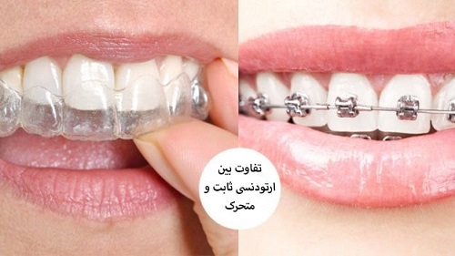 ارتودنسی ثابت بهتره یا متحرک