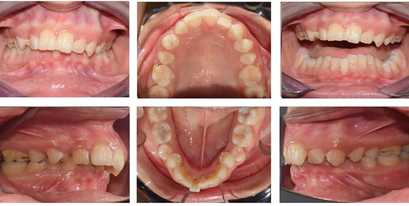 اورجت یا جلو بودن فک بالا