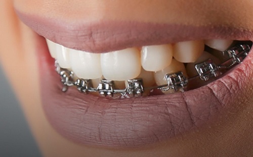 ارتودنسی یک فک