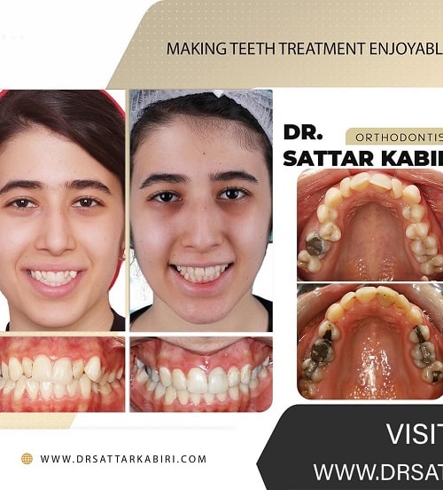 نمونه درمان بزرگی دندان ها با ارتودنسی و کشیدن دندان در کرج