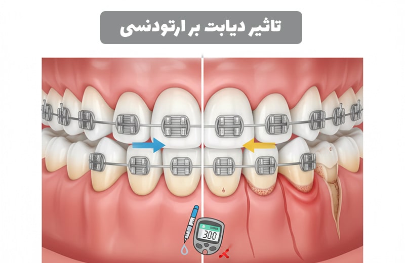 تاثیر دیابت بر ارتودنسی