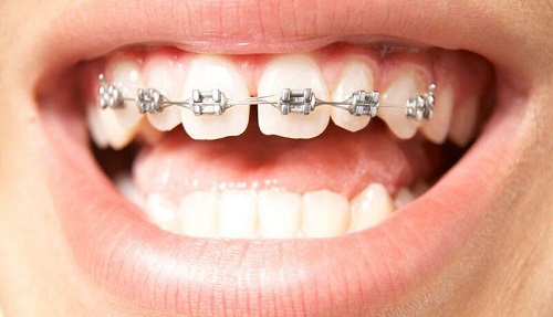 ارتودنسی بدون کشیدن دندان