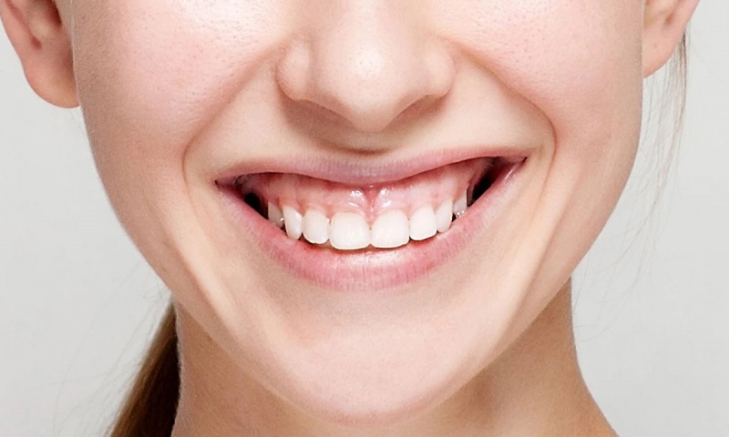 چگونه بهترین درمان را برای اصلاح لبخند لثه ای تشخیص می دهند؟