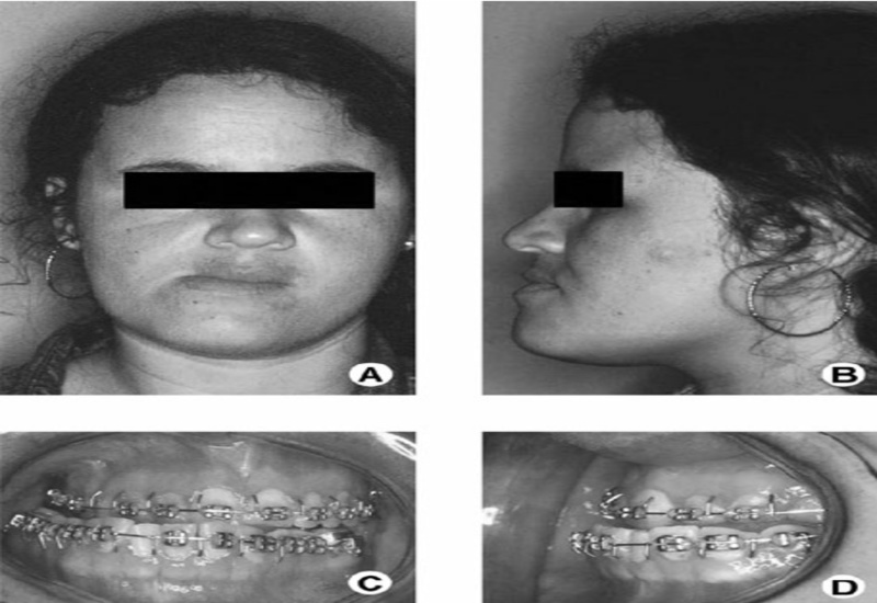 درمان انحراف فک با ارتودنسی پیشگیرانه