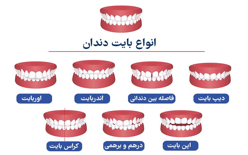 انواع بایت دندان