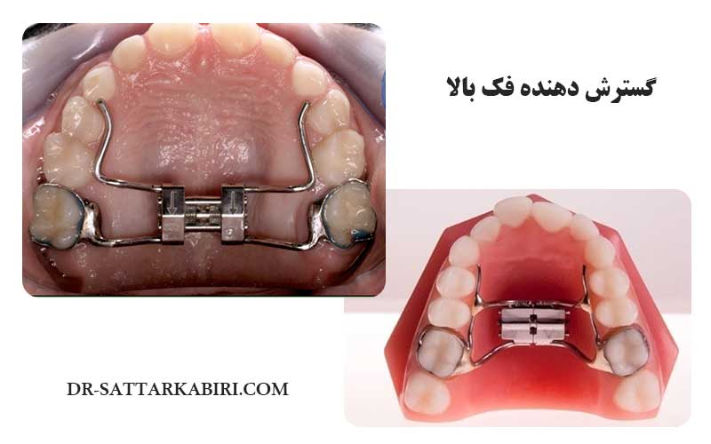 گسترش دهنده فک بالا چیست؟