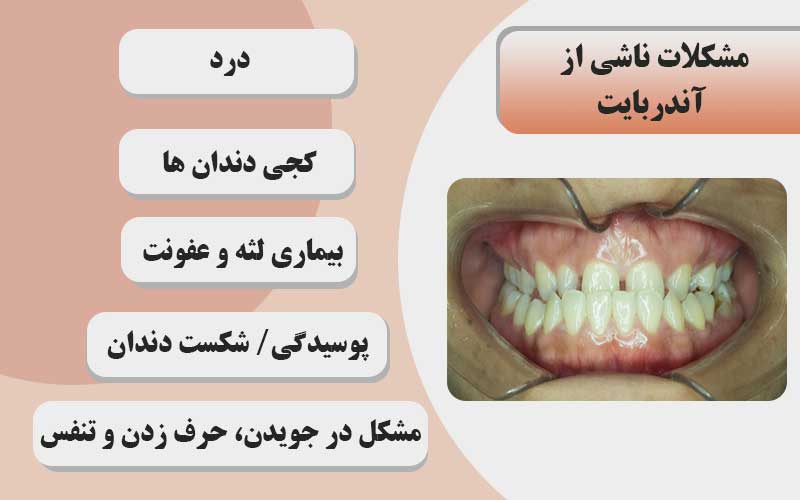 مشکلات ناشی از آندر بایت دندان 