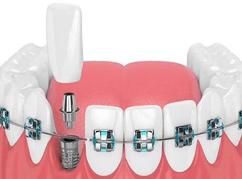 ارتودنسی دندان ایمپلنت شده
