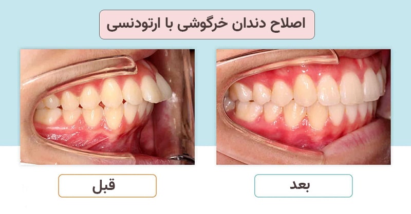 دندان خرگوشی چیست و چگونه درست می شود؟