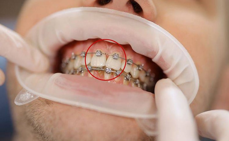 ارتودنسی دندان خرگوشی