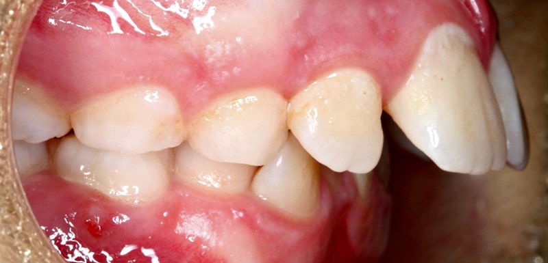 درمان جلو بودن دندان ها و لب (ناهنجاری اورجت)